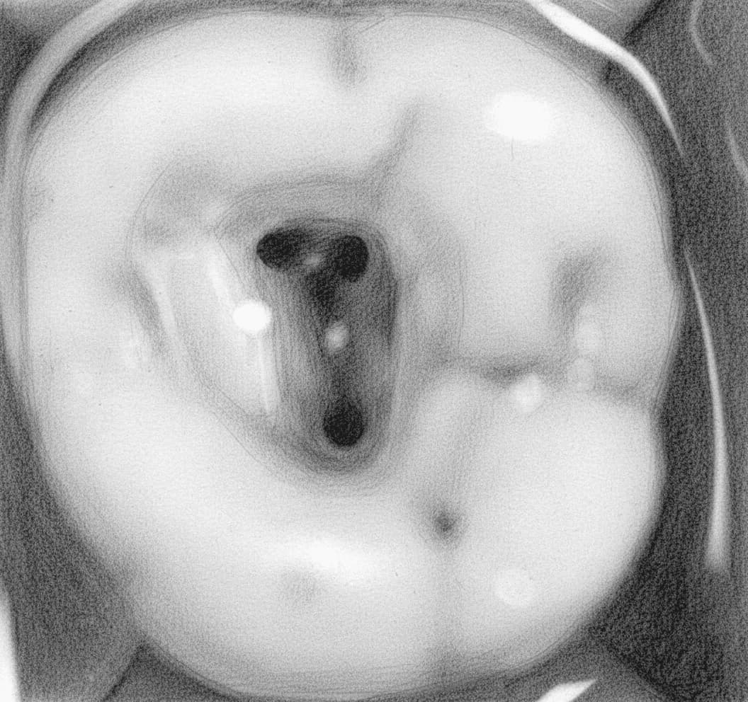 Maxillary Second Molar - Axial View showing triangular access with closely spaced canal orifices