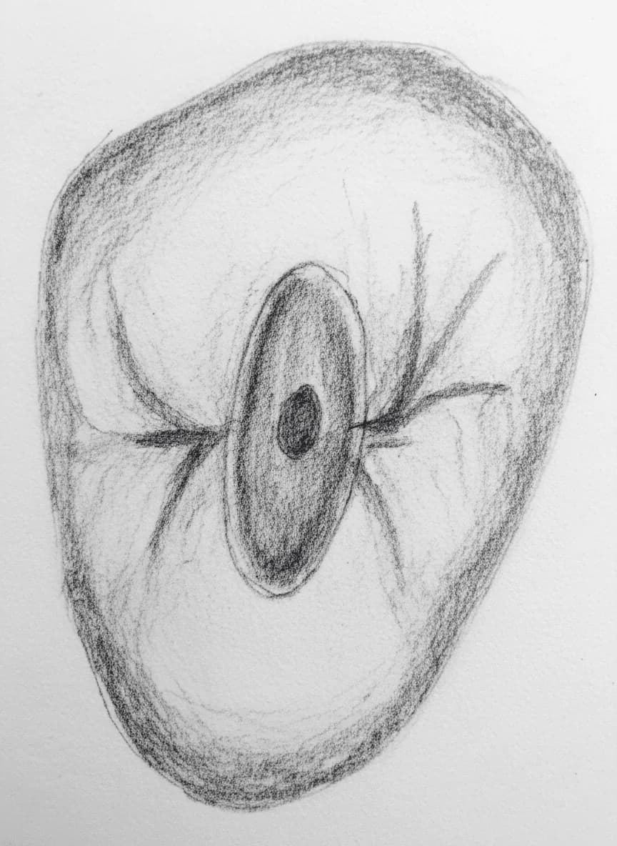 Maxillary Second Premolar - Axial View showing ovoid access cavity with variable canal anatomy (Vertucci Types I-IV)